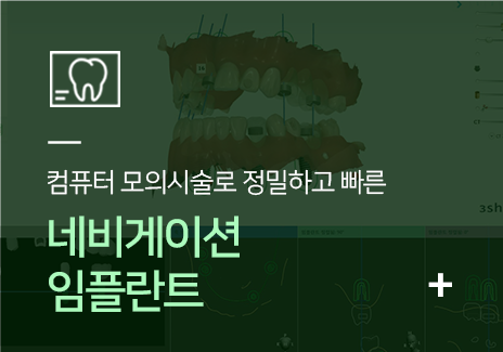 컴퓨터 모의시술로 정밀하고 빠른 네비게이션 임플란트